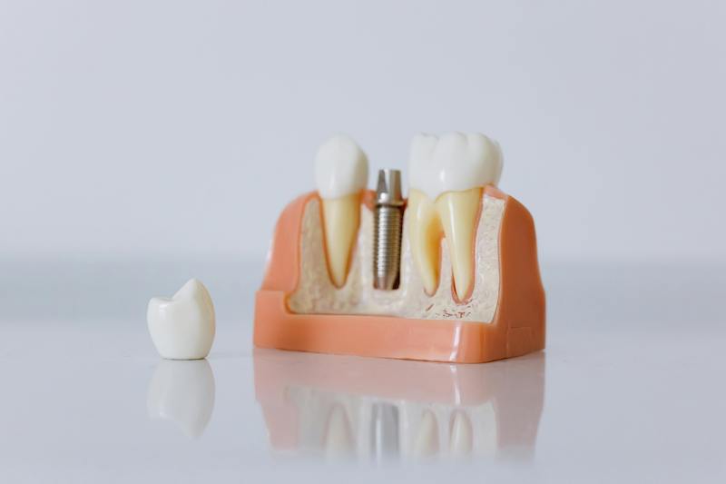 Dental Bridges Vs Implants Choosing The Right Solution For Tooth Dental Bridges Vs Implants Choosing The Right Solution For Tooth
