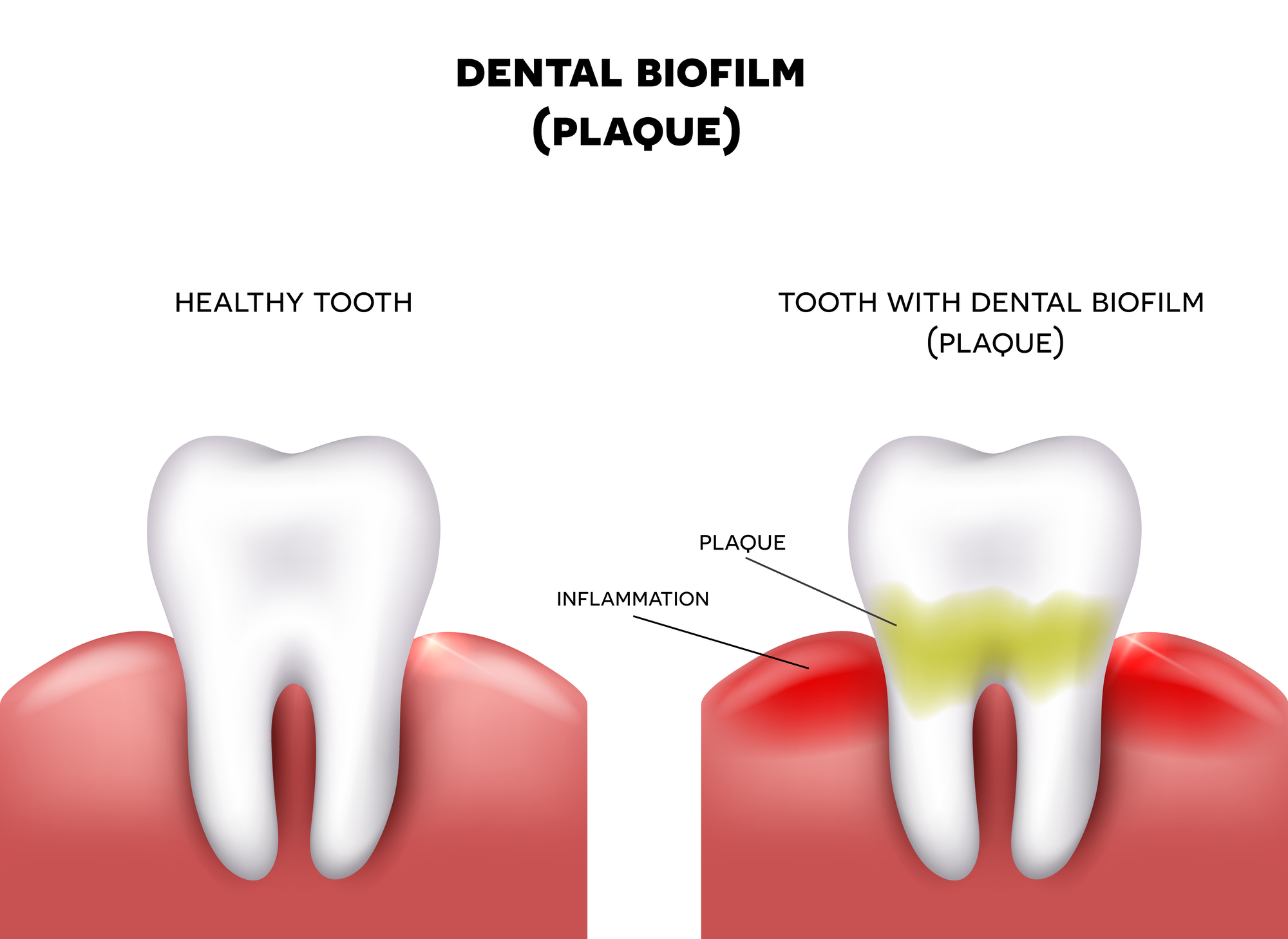 Dental Calculus Removal Cost