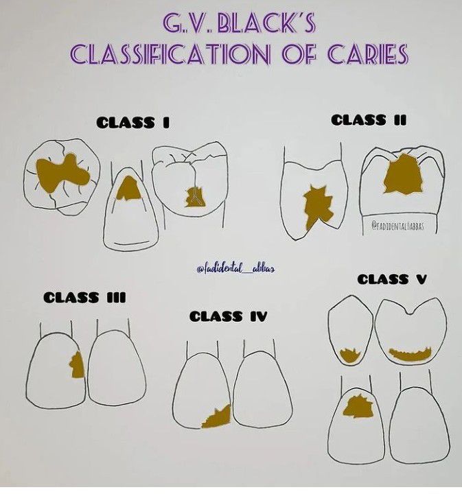 Dental Cavity Classes