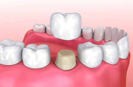Dental Crown Bridges