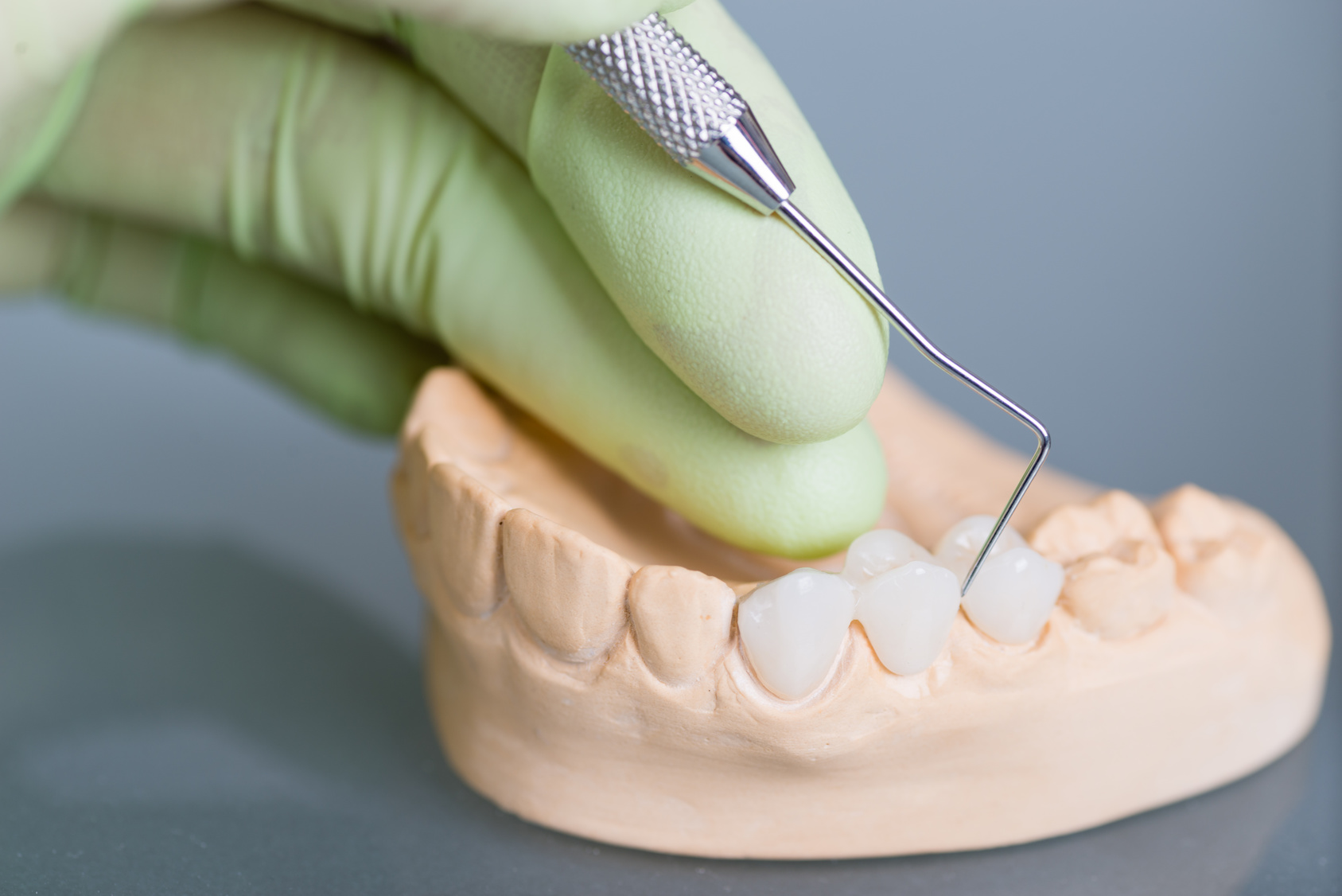 Dental Crown Vs Bridge