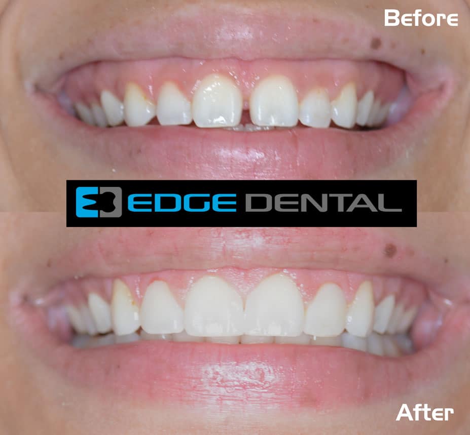 Dental Filling: Minimizing Discomfort