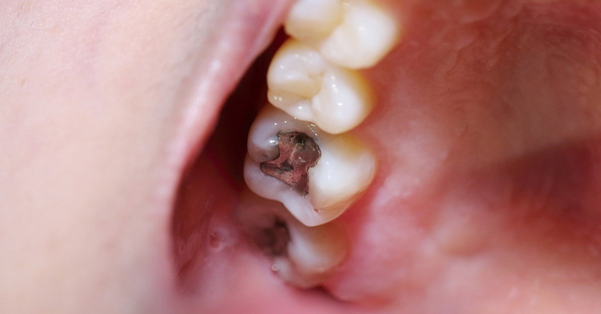 Dental Filling Pain Afterwards