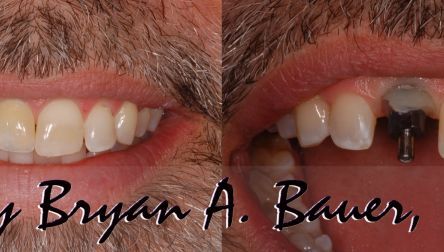 Dental Flipper Choices What Are Your Options What S Cost Dental Flipper Choices What Are Your Options What S Cost