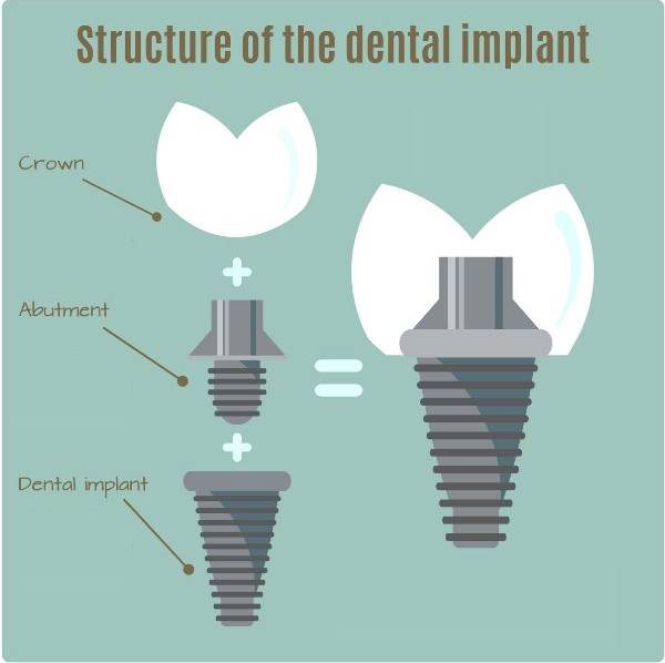 Dental Glue For Crowns