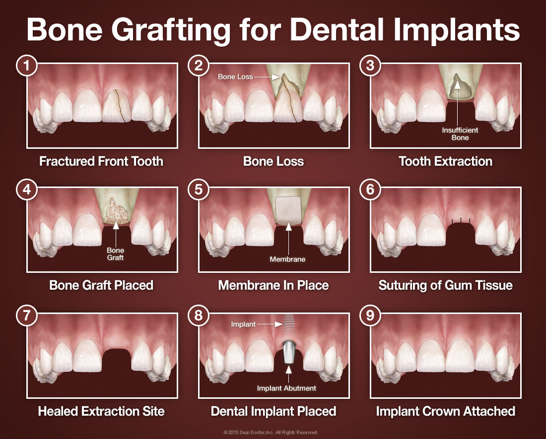 Dental Implant Soreness