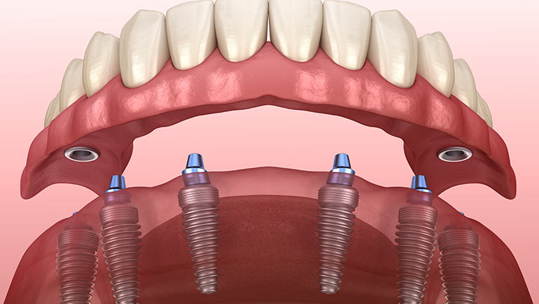 Dental Implants Or Mini Implants