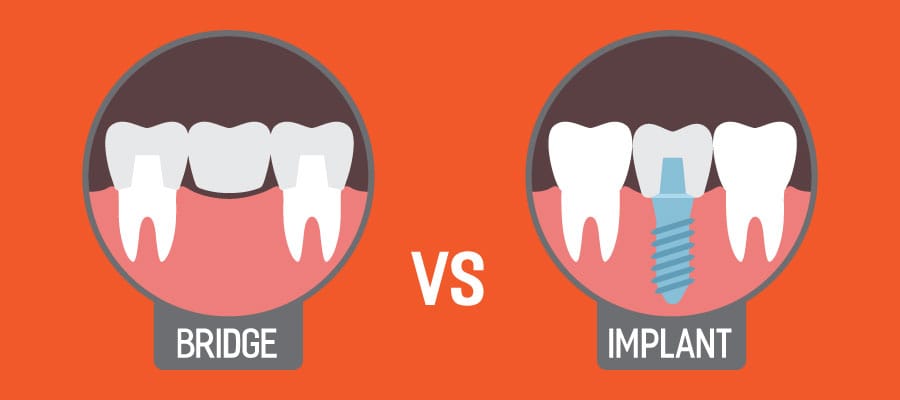 Dental Implants Vs Bridges Finding What S Best For You Dr Karve S Dental Implants Vs Bridges Finding What S Best For You Dr Karve S