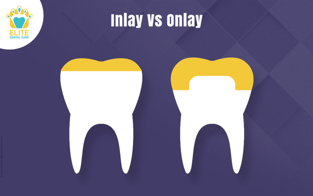 Dental Inlay Onlay: Comprehensive Care Solutions