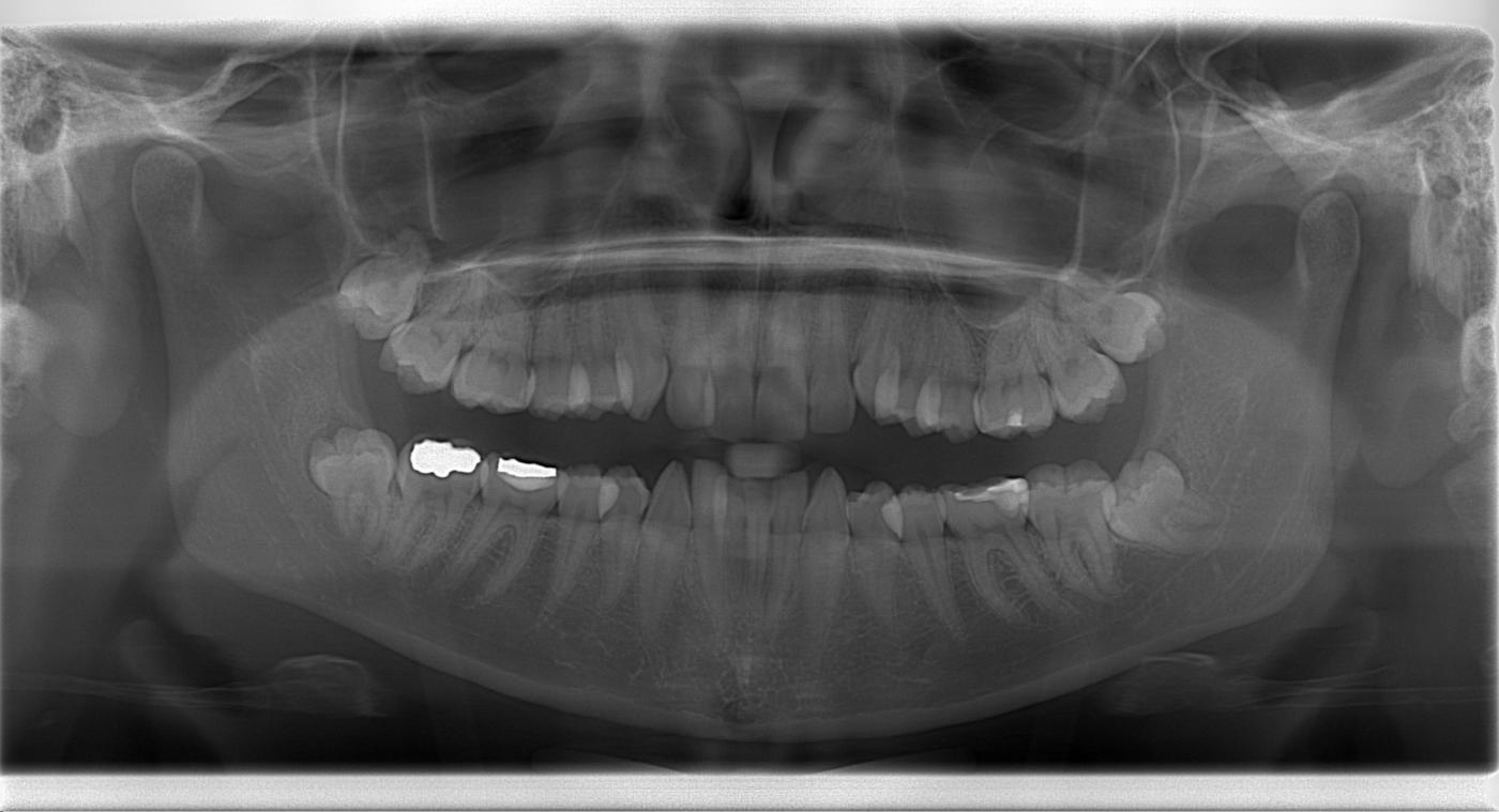 Dental Pan X Ray