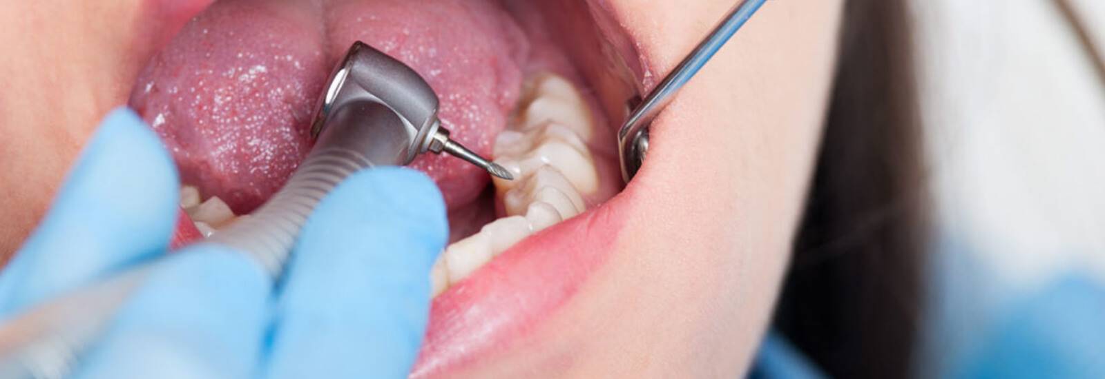 Dentist Tartar Removal Tool: Removes Plaque Easily