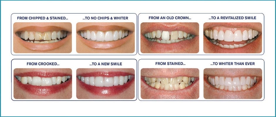Dentists That Do Veneers