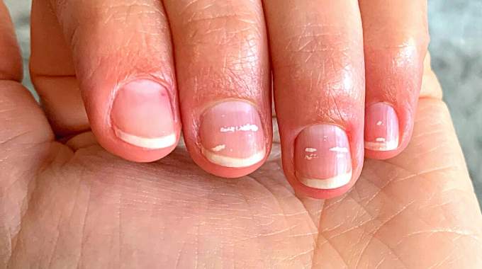 Dents Taches Blanches: Causes Révélées Dents Taches Blanches: Causes Révélées
