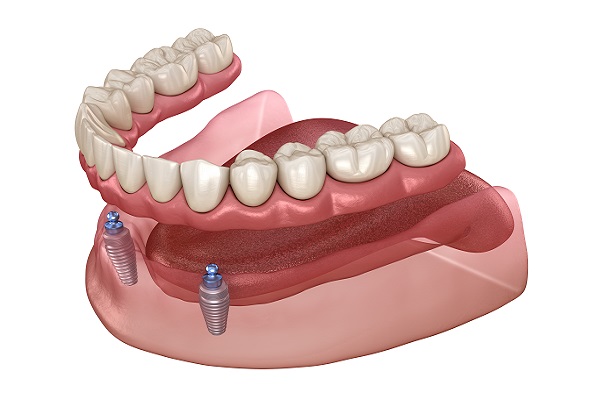 Denture Implants: Smile Confidence Guaranteed