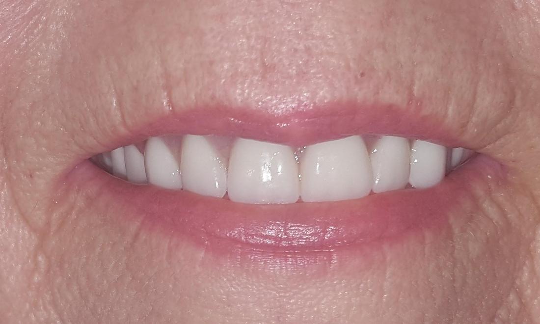 Dentures Before 40: Restore Smile Confidence