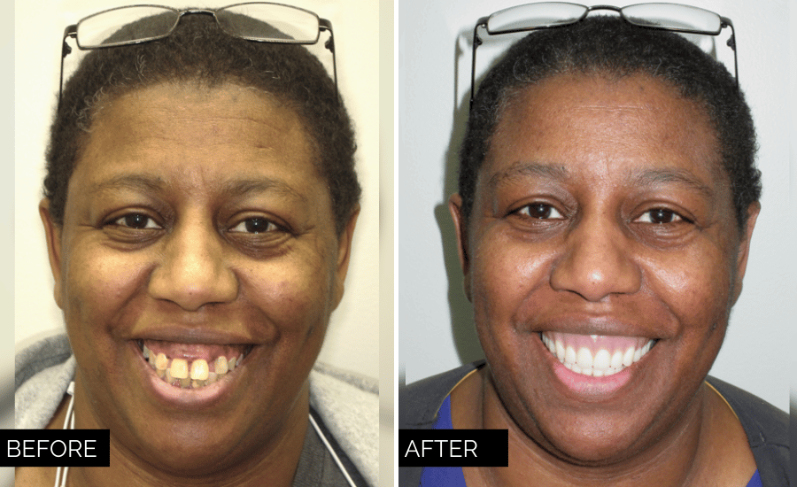 Dentures In 30S