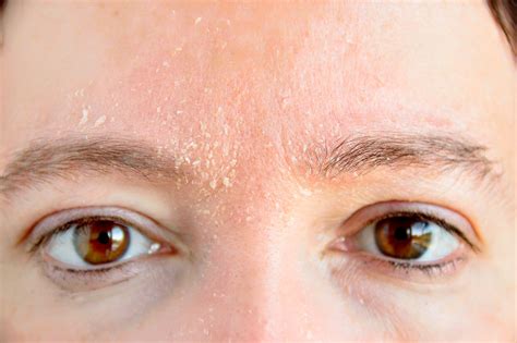Dermatitis Seborreica Fotos Cara