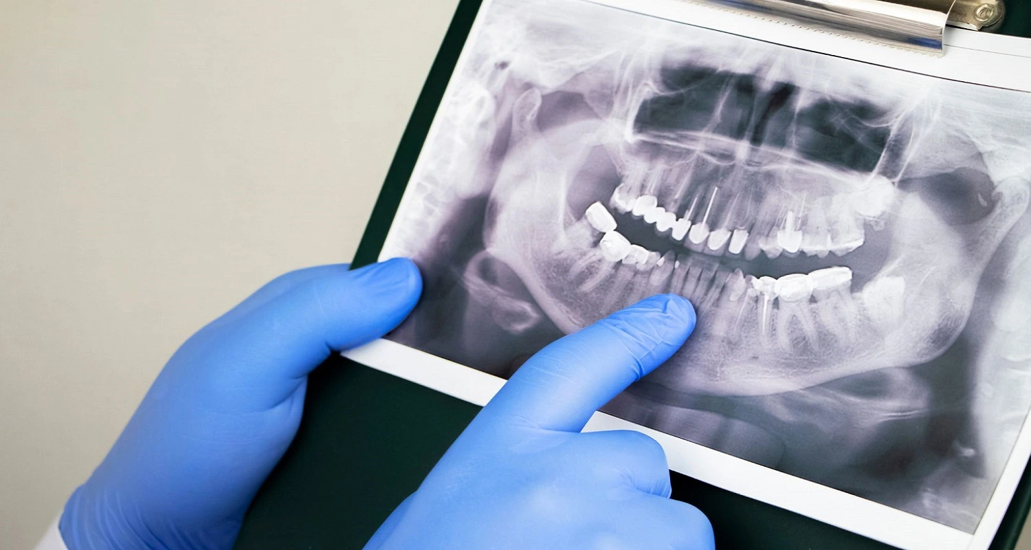 Dislocation Of Tooth