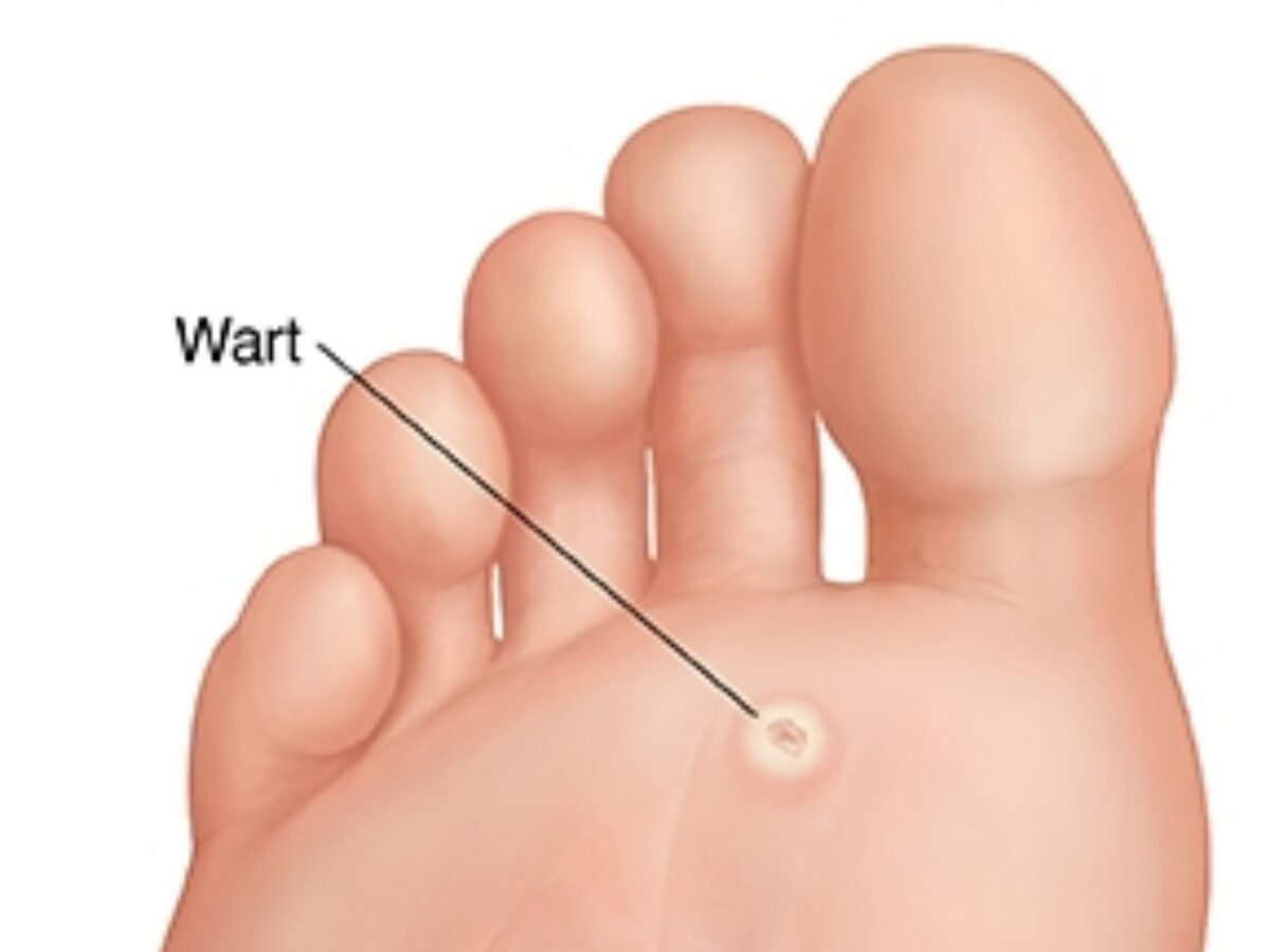 Do Hpv Warts Have Pus
