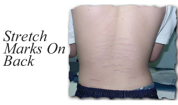 Do Men Get Stretch Marks Do Men Get Stretch Marks