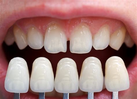 Do You Know The Difference Between Lumineers And Veneers Dr Taylor Do You Know The Difference Between Lumineers And Veneers Dr Taylor