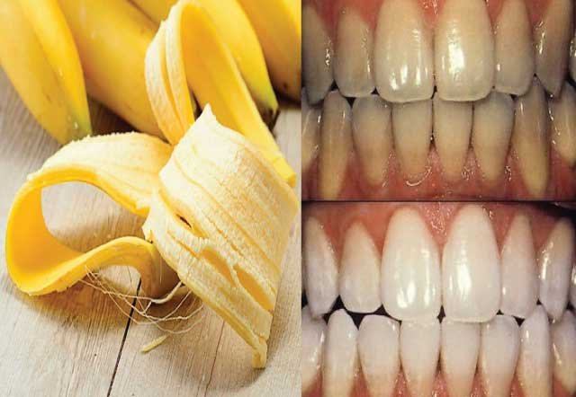 Does Banana Skin Whiten Teeth