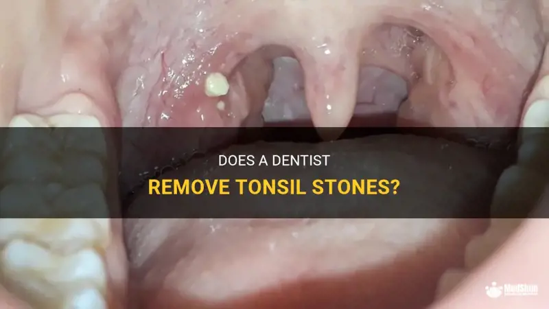 Does Dentist Remove Tonsils