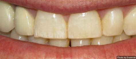 Does Fluoride Yellow Teeth Does Fluoride Yellow Teeth