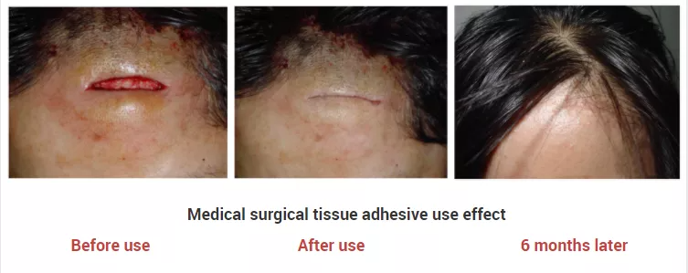 Does Surgical Glue Fall Off