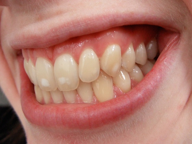 Does Tea Stain The Teeth