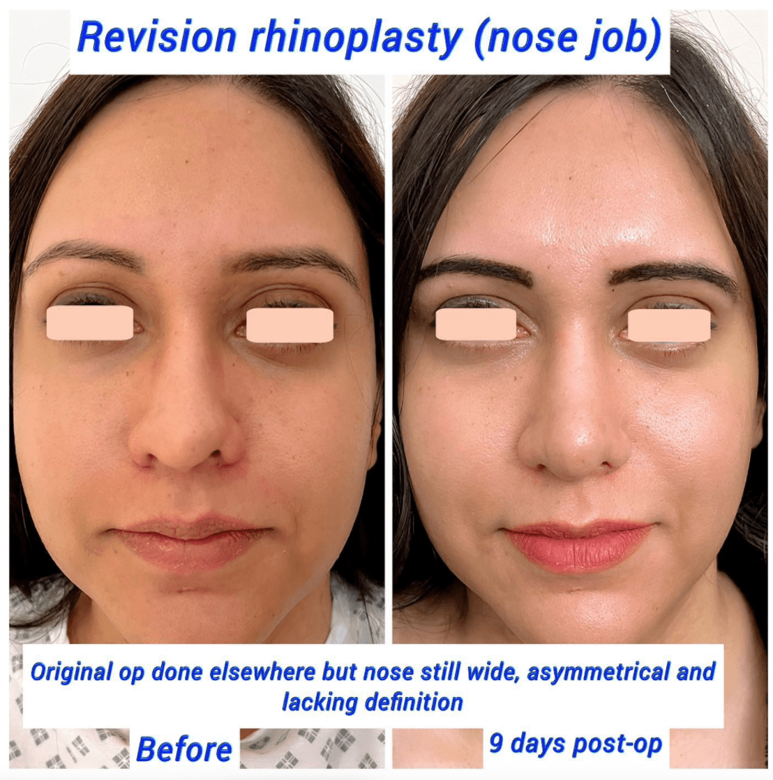 Does Your Nose Keep Growing After Rhinoplasty Surgery Harley Clinic Does Your Nose Keep Growing After Rhinoplasty Surgery Harley Clinic