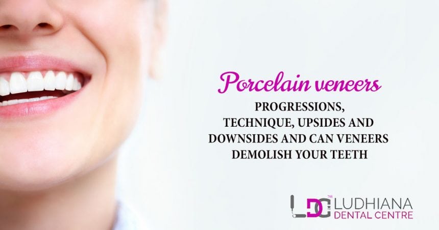 Downsides Of Veneers