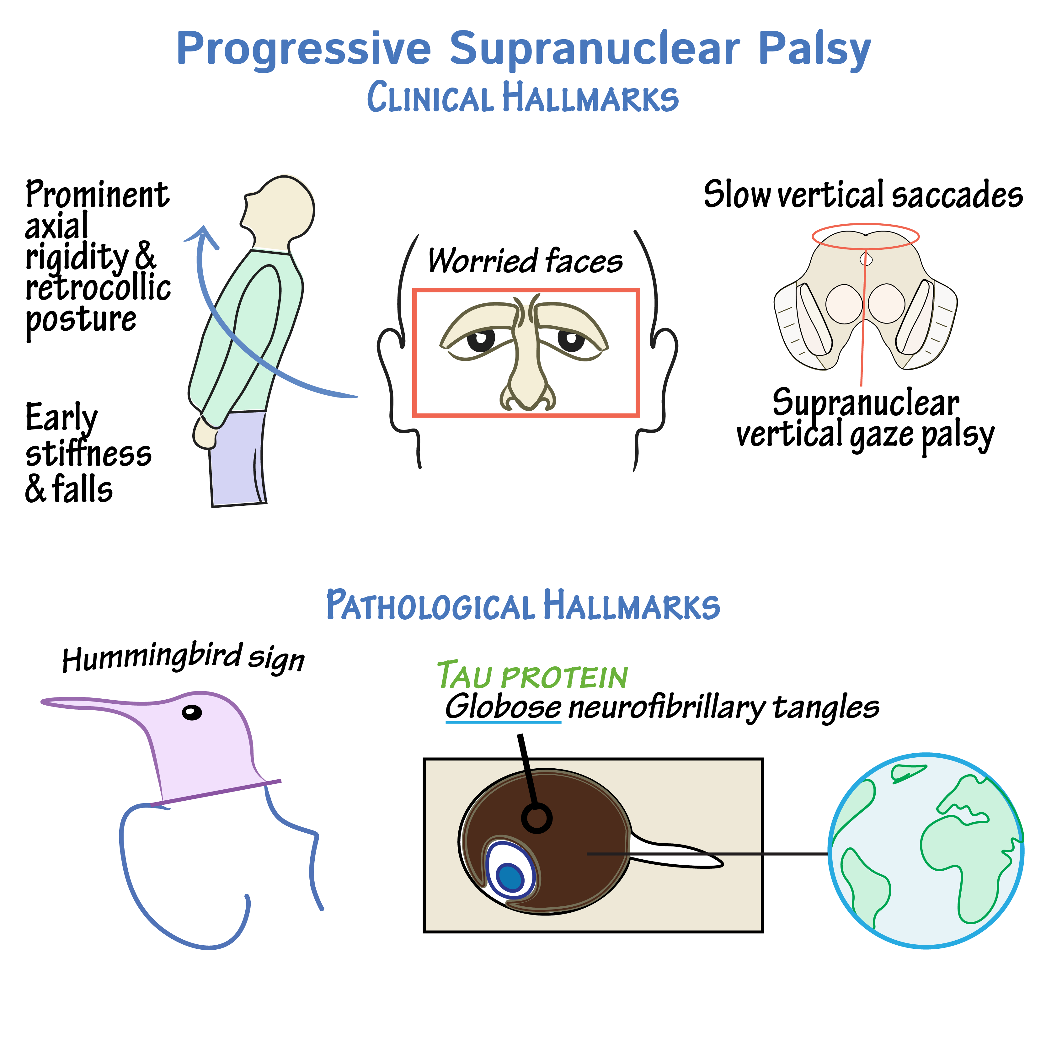 Downward Gaze Palsy