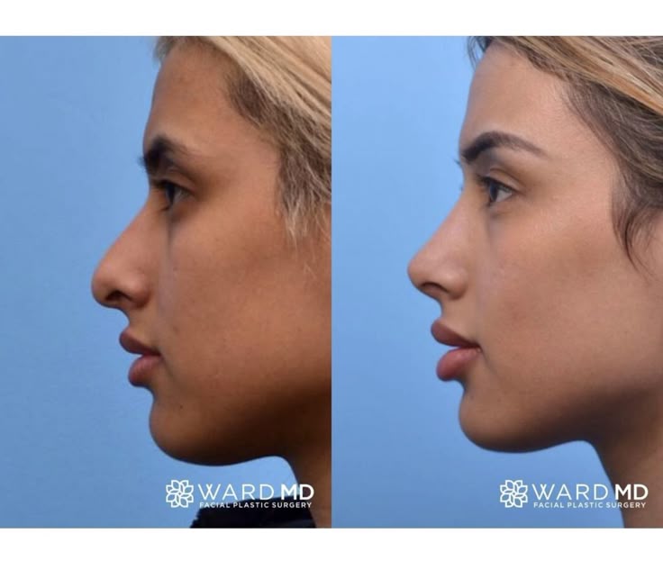 Droopy Nose Tip Clinicexpert Droopy Nose Tip Clinicexpert