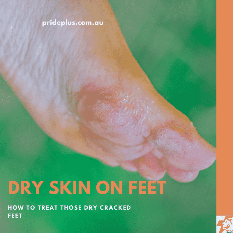 Dry Feet: Fix Cracks With Natural Remedies