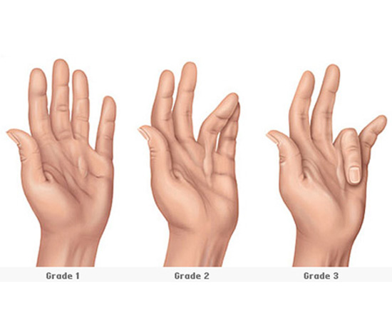 Dupuytren's Contracture After Surgery