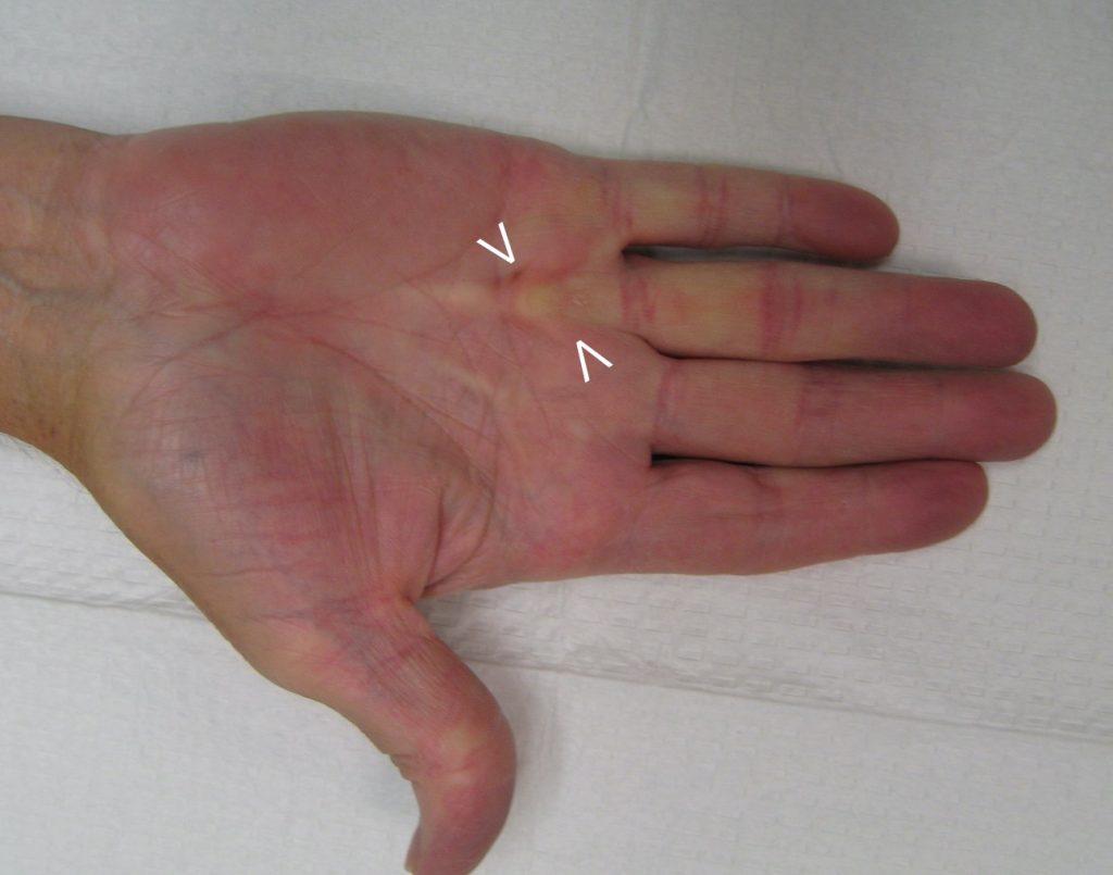 Dupuytren's Contracture Healing Plan