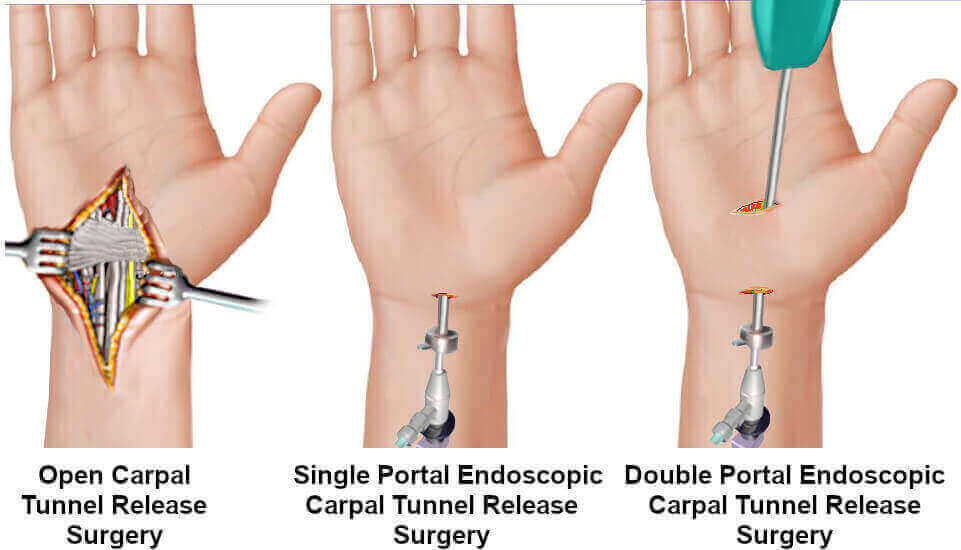 Endoscopy Carpal Tunnel Surgery