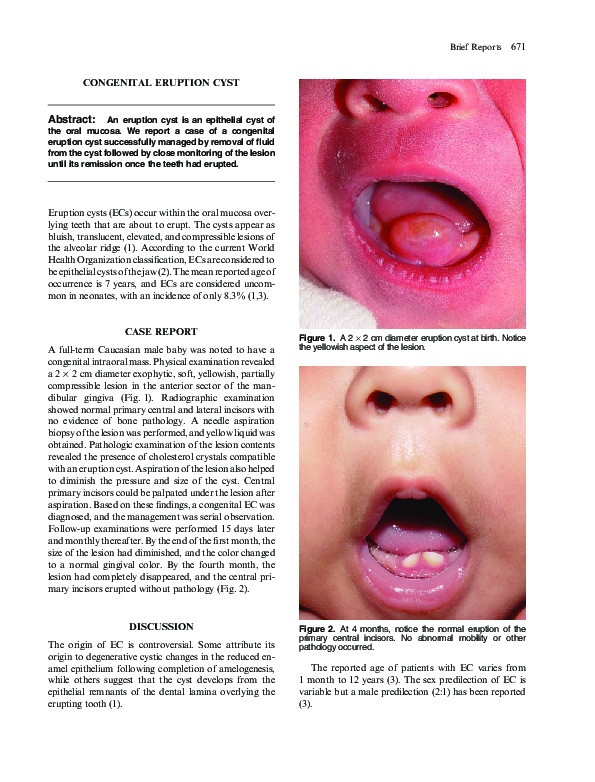 Eruption Cyst: Relief For 7 Year Olds