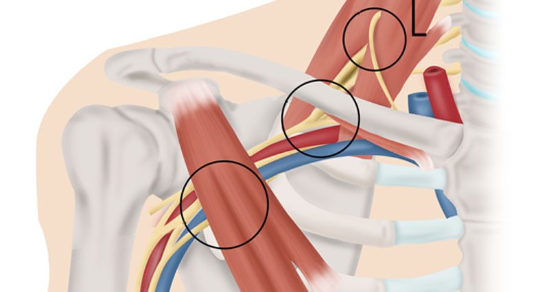 Exercises For Tos Syndrome