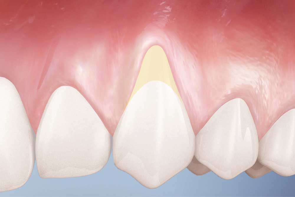 Exposed Roots Teeth Guide: Coverage Options