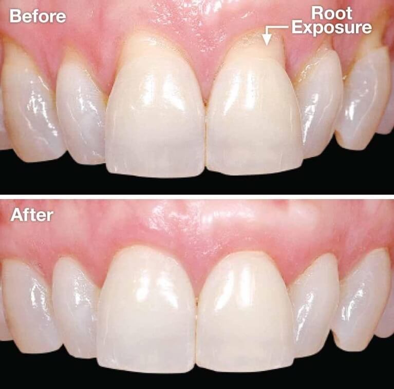 Exposed Tooth Root Treatment Guide