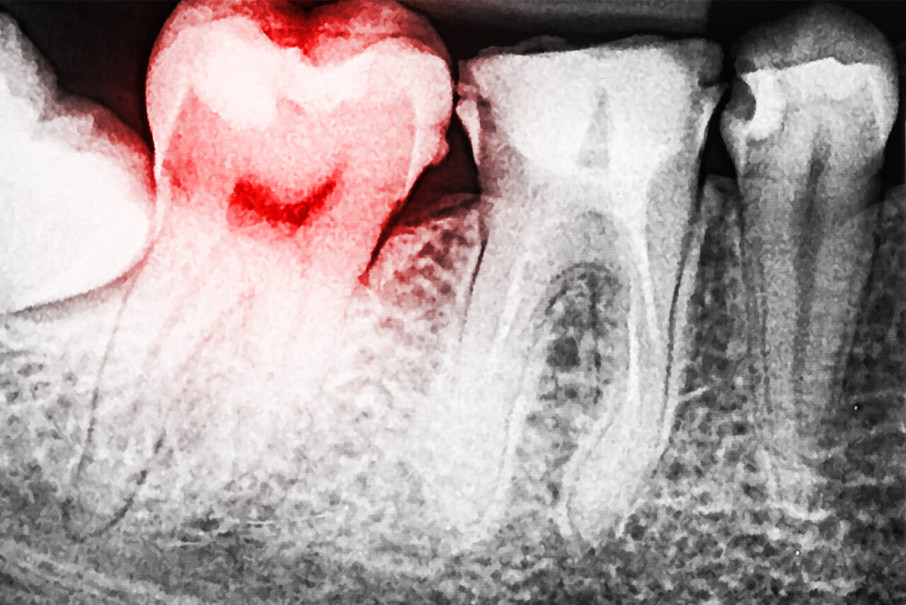 Exposed Tooth Root