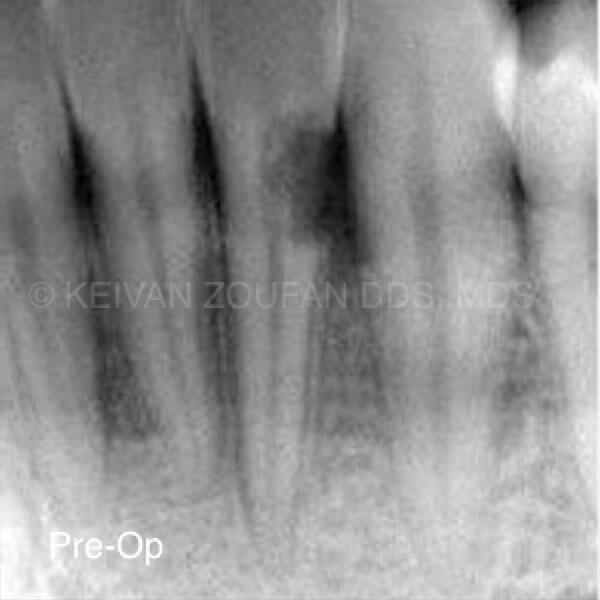 External Cervical Root Resorption Treatment And Outcome External Cervical Root Resorption Treatment And Outcome