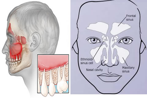 Eye Pain With Toothache