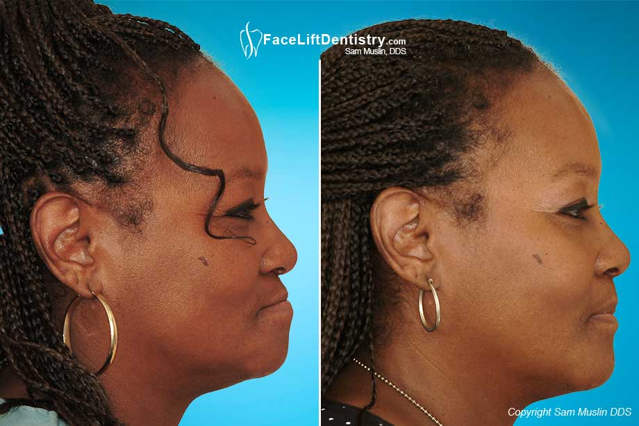 Facelift Dentures Near Me: Smile Restoration Solutions Facelift Dentures Near Me: Smile Restoration Solutions