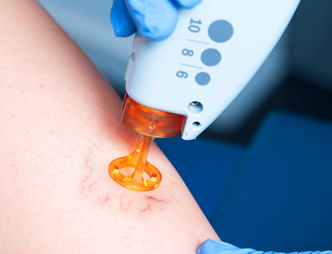 Facial Vascular Lesions Treatment Options