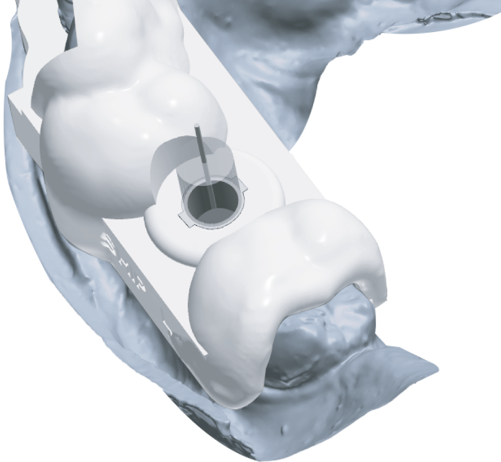 Failed Implant Guide: Diagnosis And Solutions