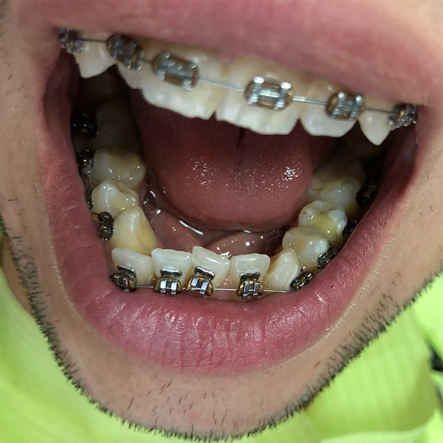 Fake Braces Info: Risks And Benefits Explained Fake Braces Info: Risks And Benefits Explained
