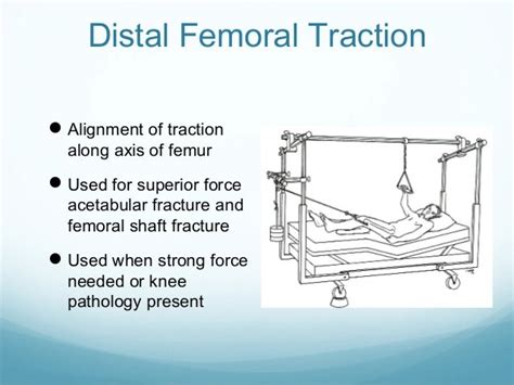 Femur Fracture Traction: Heal Faster At Home Femur Fracture Traction: Heal Faster At Home